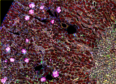 The podocyte adhesome in the development of FSGS