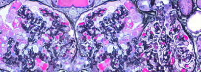 MCD/FSGS registry and digital nephropathology