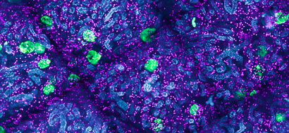 Mononuclear phagocytes in the development of FSGS