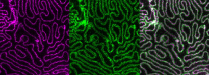 Alterations of slit diaphragm signaling as a cause of FSGS