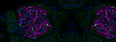 Targeting metabolic pathways in focal segmental glomerulosclerosis